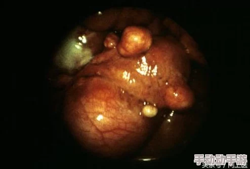 睾丸进入子宫的里面长肉粒正常吗？专家称这可能与某种罕见病症有关，网友热议背后真相！